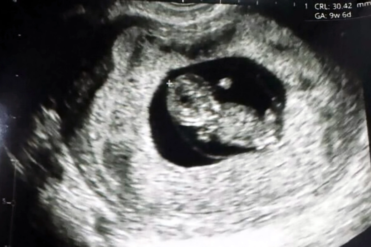 An ultrasound of the 'Fertilo baby' taken at nine weeks