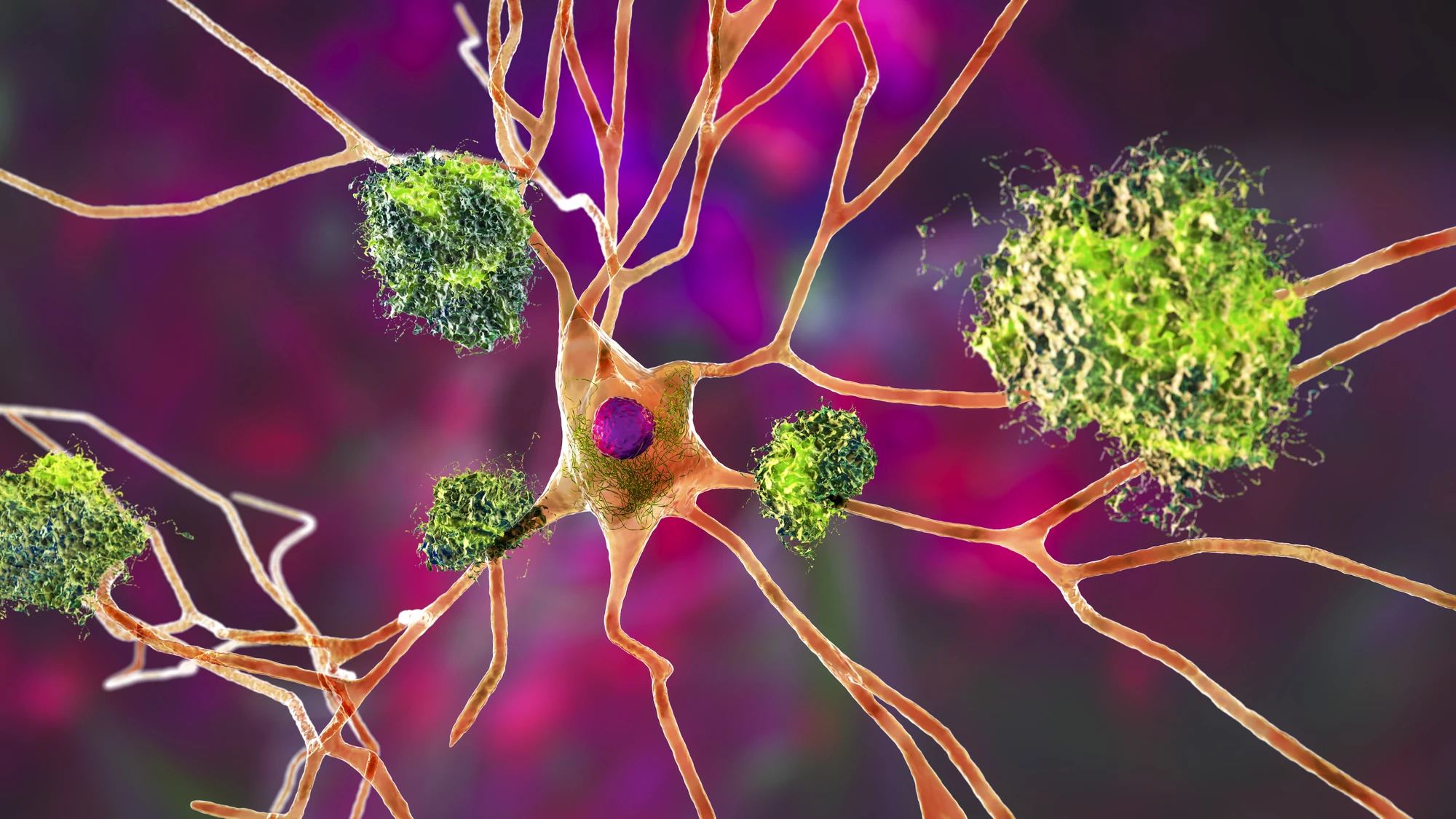 An artist's depiction of amyloid plaques surrounded by tau tangles, both considered key pathological signs of Alzheimer's disease