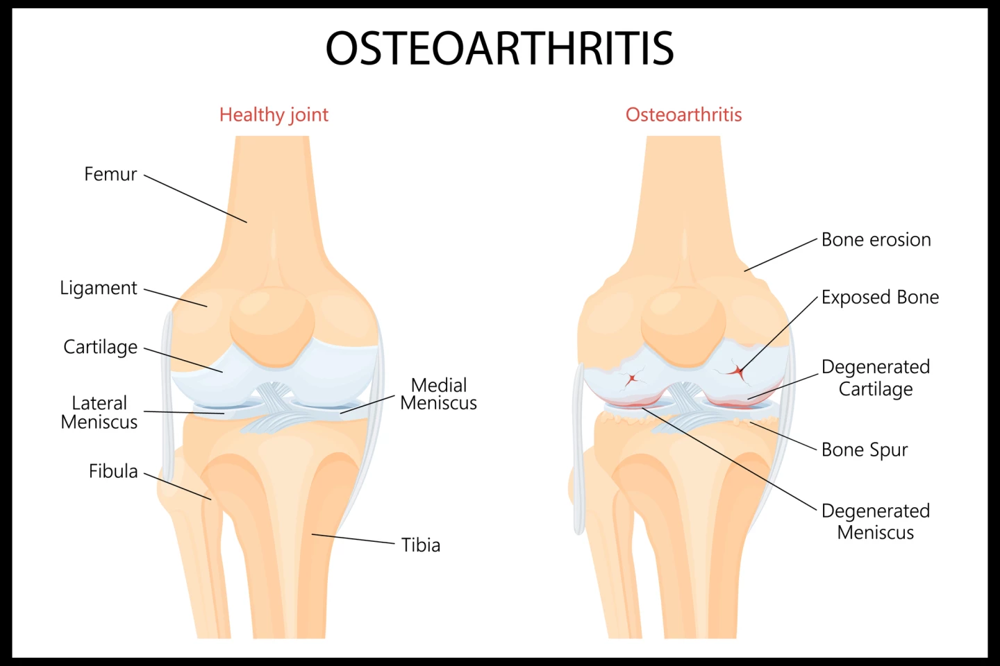 The anatomy of knee osteoarthritis