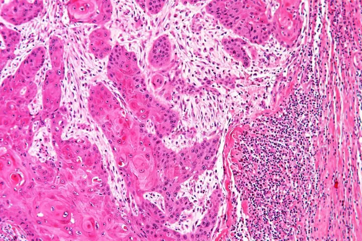 Cancer under a microscope, with the black dots on the right showing lymphocytes which are trying to penetrate a tumor, but are being prevented by corrupted healthy cells called by cancer-associated fibroblasts
