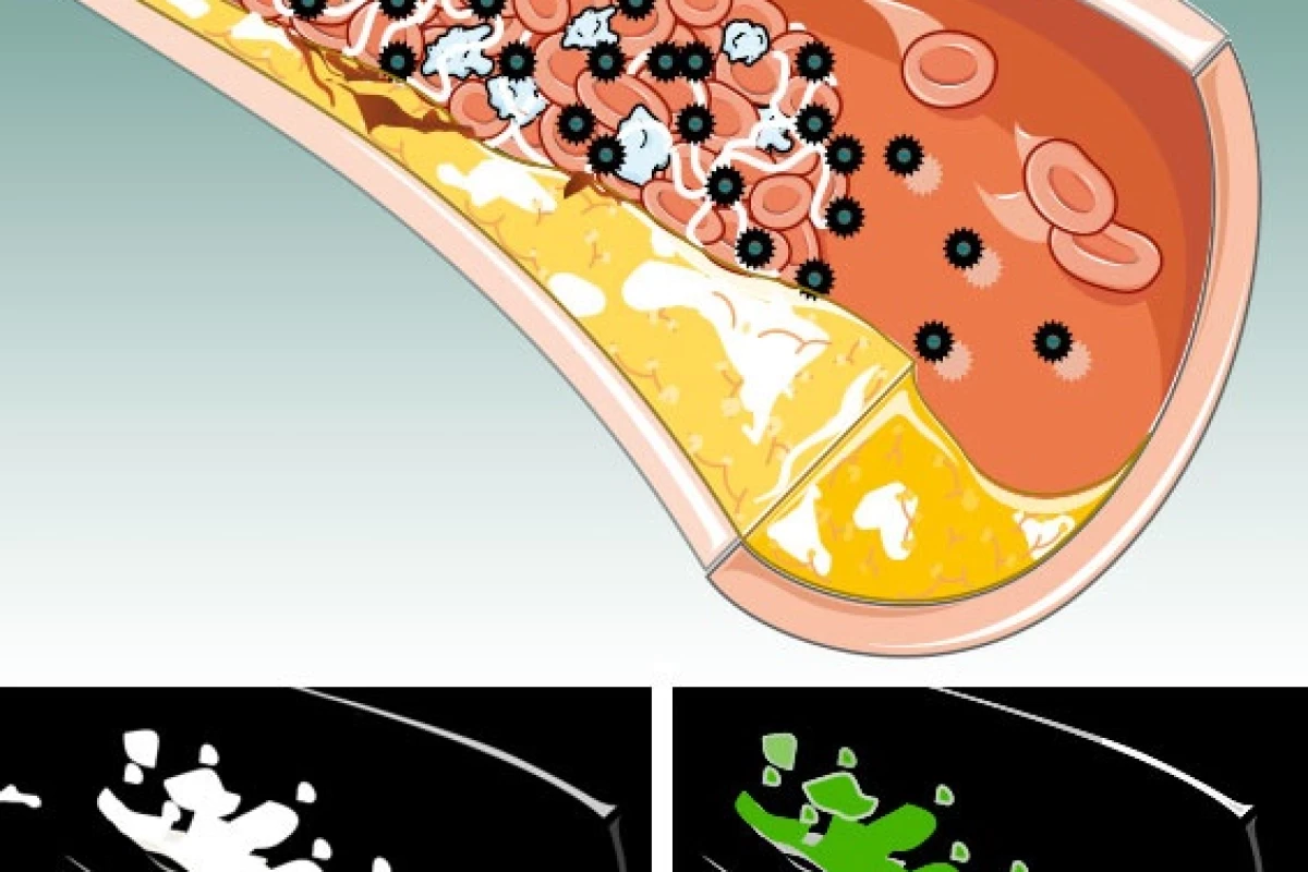 A nanoparticle-based process allows blood clots to show up on a new type of CT scan (Image: Wiley-VCH Verlag GmbH & Co. KGaA.)