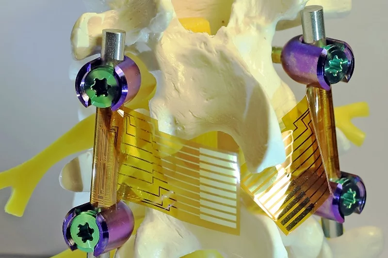 Implant shown attached to spinal vertebrae