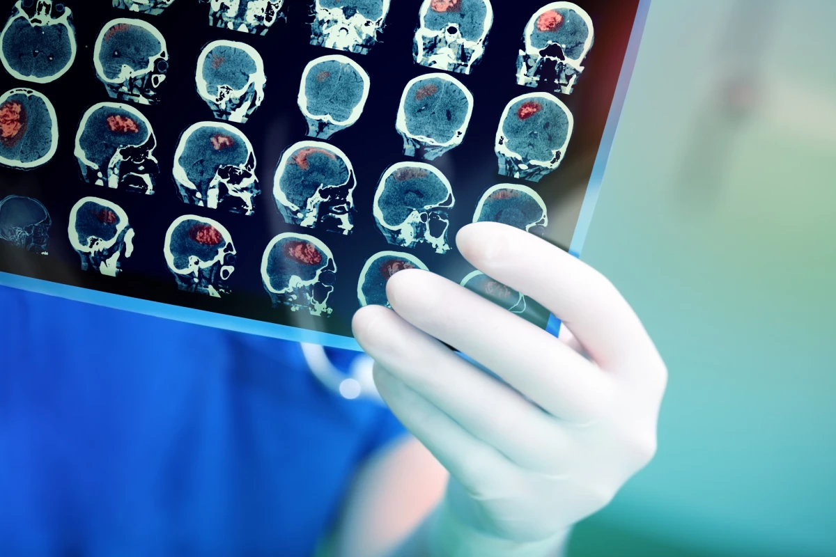 A study found an old schizophrenia drug may increase the efficacy of radiation therapy treating aggressive brain cancer