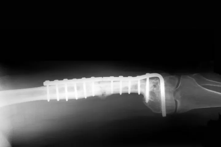Scientists have developed a tiny sensor that could wirelessly transmit data on the status of orthopedic implants, like this one (Photo via Shutterstock)