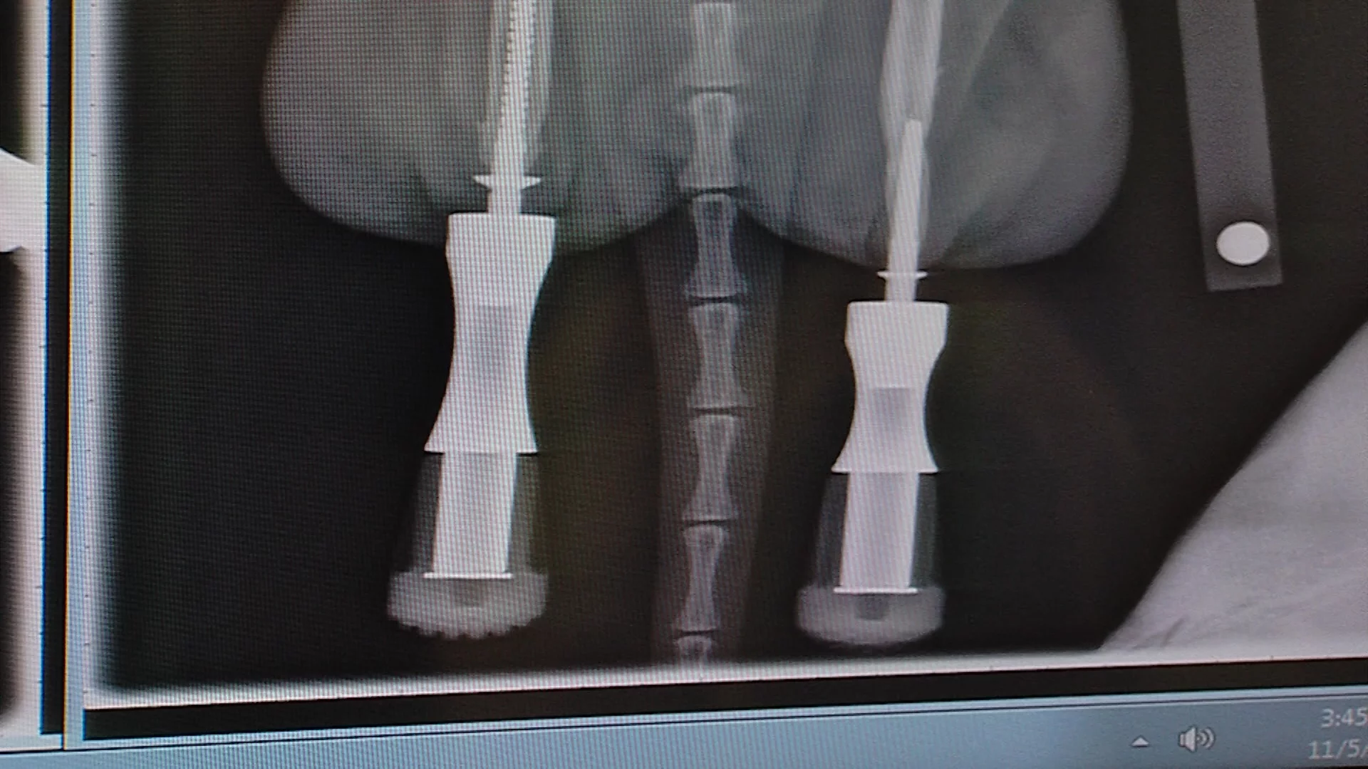 An x-ray showing the placement of the prosthetic legs