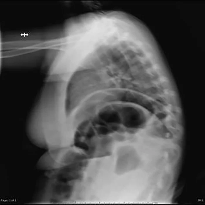 Blurred X-ray images such as this one, which result in retakes and more exposure to radiation, is something the researchers are hoping to avoid