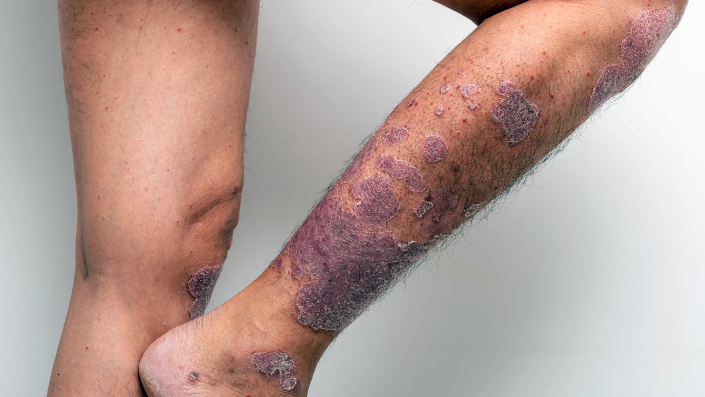 Rubedo's drug, RLS-1469, is designed to treat chronic skin conditions like psoriasis