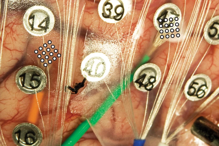 Larger, numbered button-like electrodes (ECoGs) alongside the microECoGs indicated by the 4x4 circle grid at the end of the green and orange wires on the brain of a volunteer patient (Image: University of Utah Department of Neurosurgery)