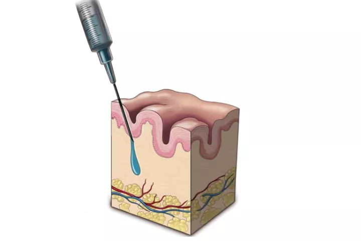 The injectable biomedical material PEG-HA has been developed to permanently replace soft tissue