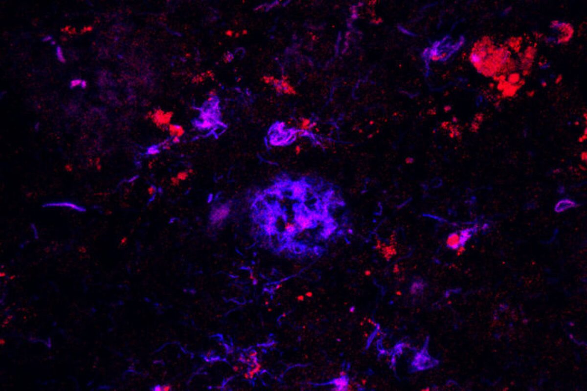 Antibodies (red) bind to the amyloid plaques (blue) in brain tissue