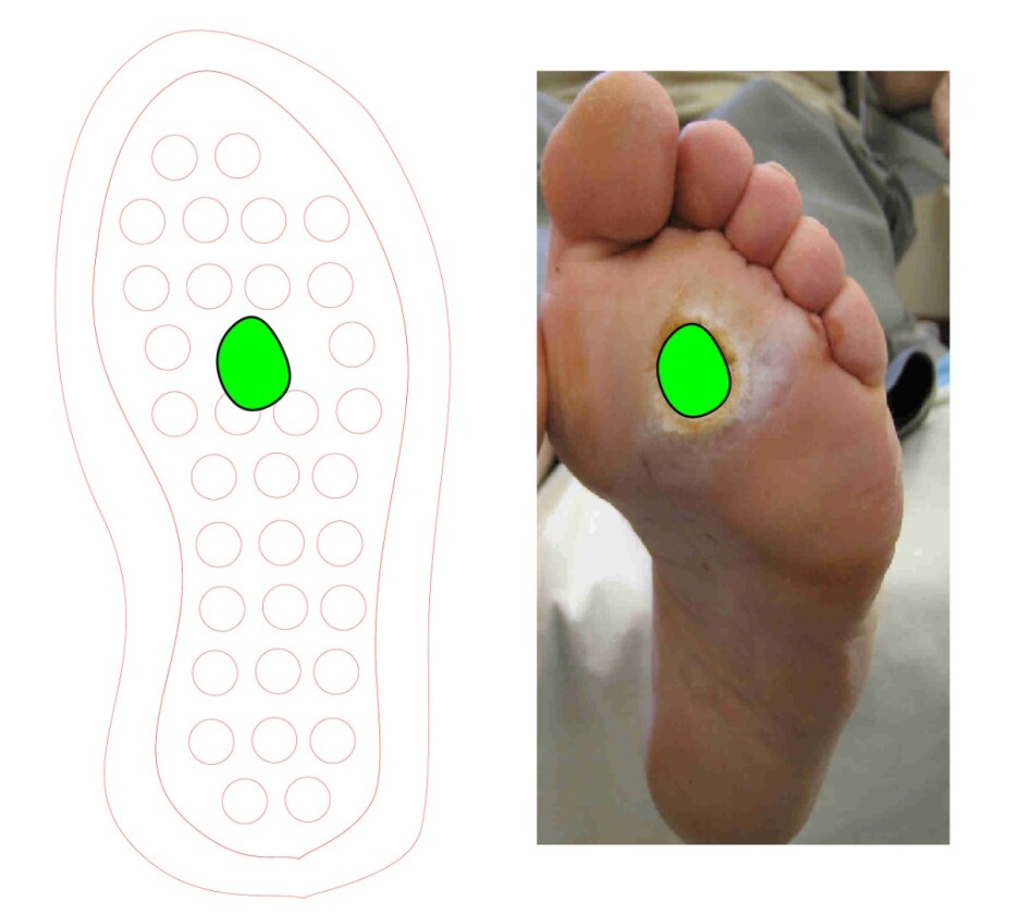 It is hoped that packs of the insoles could ultimately be 3D-printed for individual patients based on photos of the soles of their feet