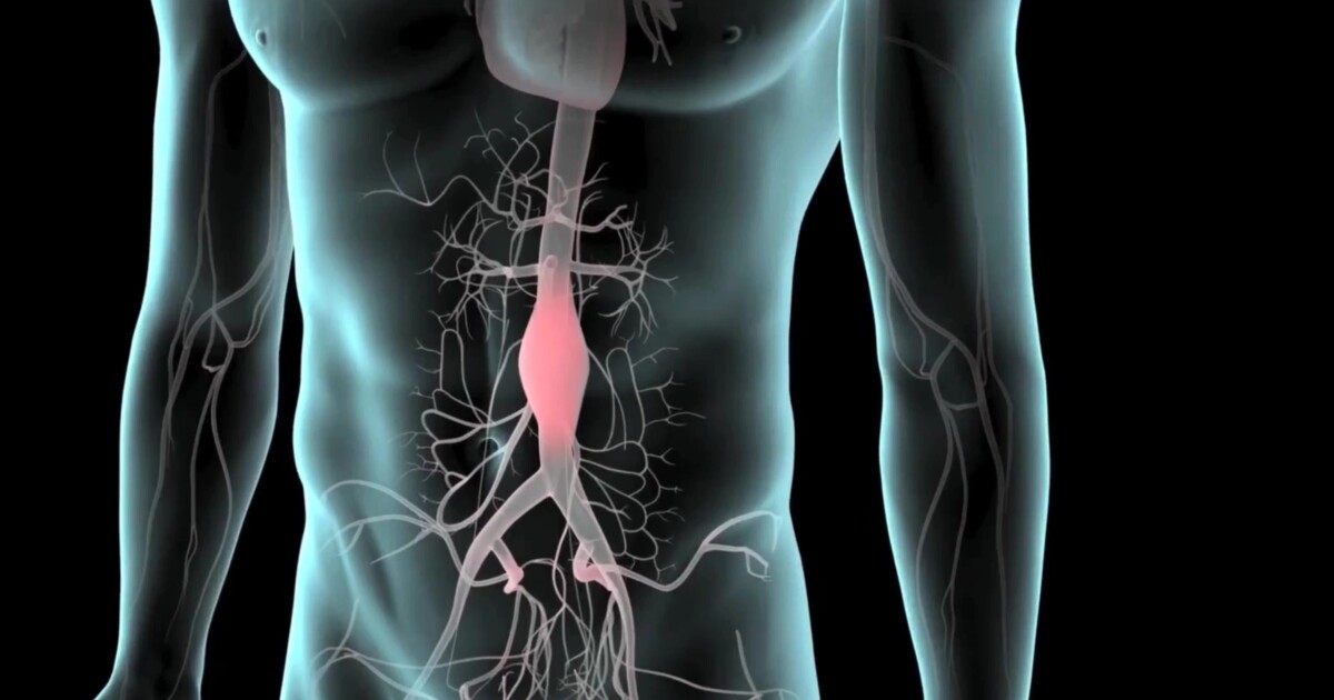Red meat linked to higher risk of aortic aneurysms Red meat linked to higher risk of aortic aneurysms