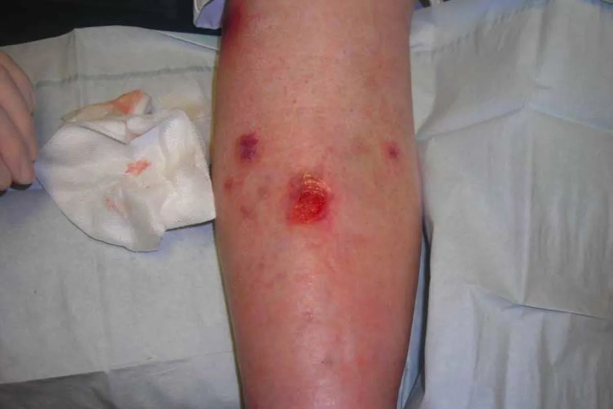 A solution containing skin cells and proteins has been shown to speed the healing of venous leg ulcers