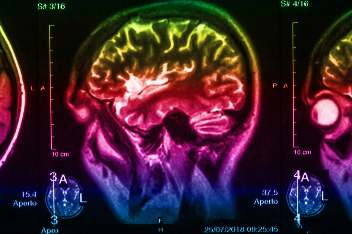A new study suggests degradation in the brain's serotonin systems could precede visible symptoms of Parkinson's disease by up to 20 years