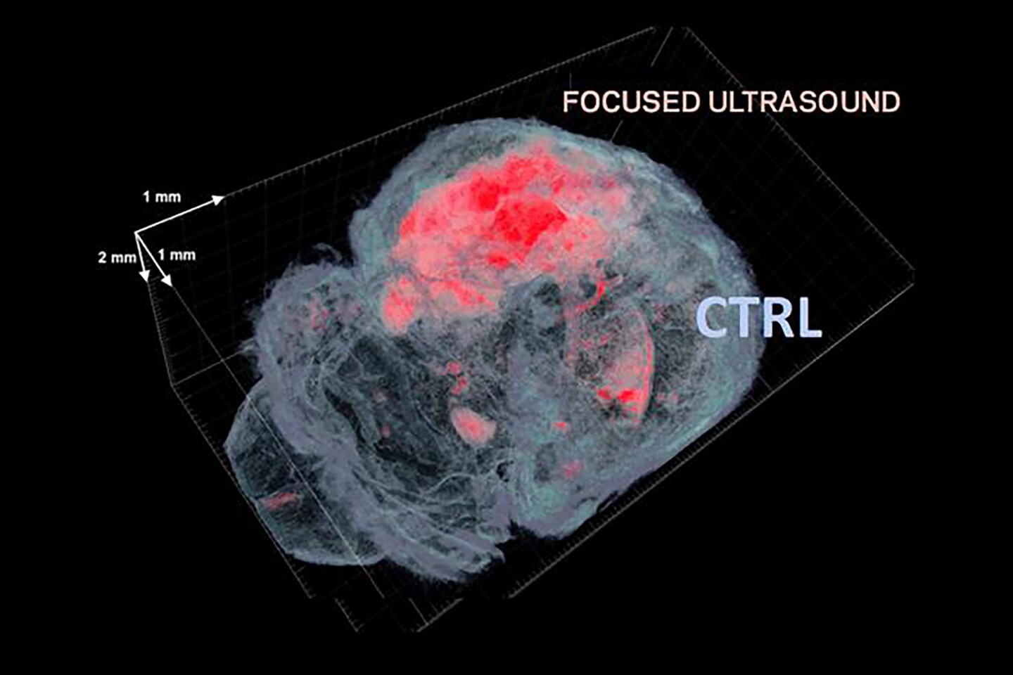 Researchers have used focused ultrasound to non-invasively open up the blood-brain barrier (red) in mice