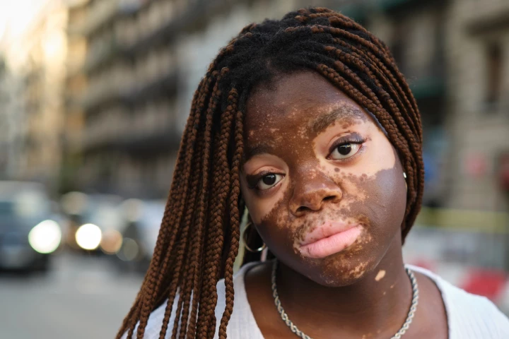 Although vitiligo isn't dangerous, it can be the source of substantial emotional distress