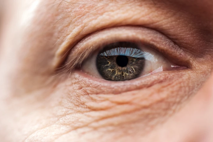 People with age-related macular degeneration have higher bloodstream levels of a protein known as FHR-4