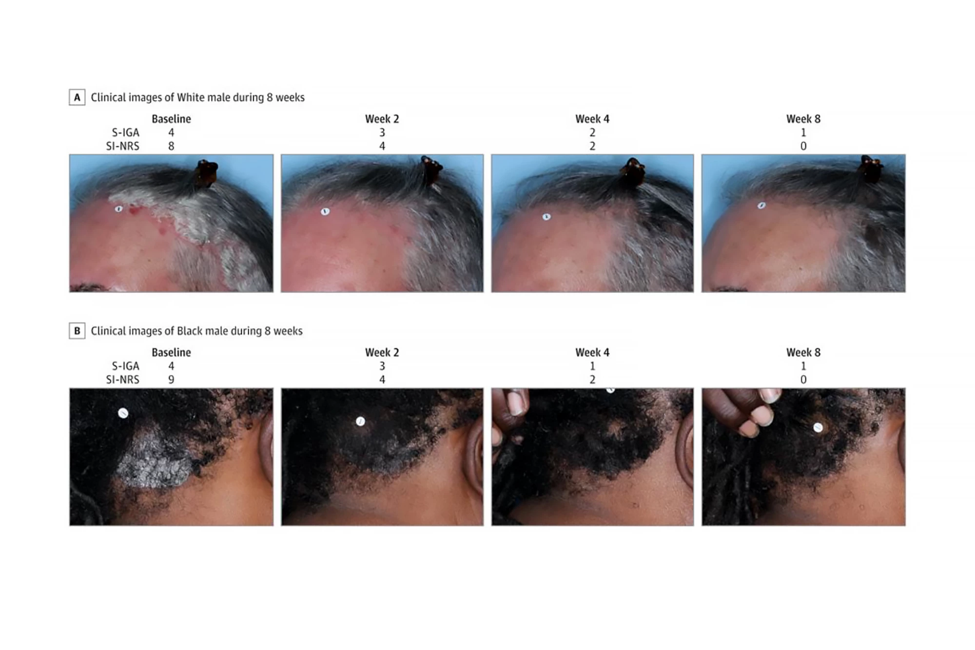 Improvement in scalp psoriasis seen in two trial participants treated with roflumilast over eight weeks