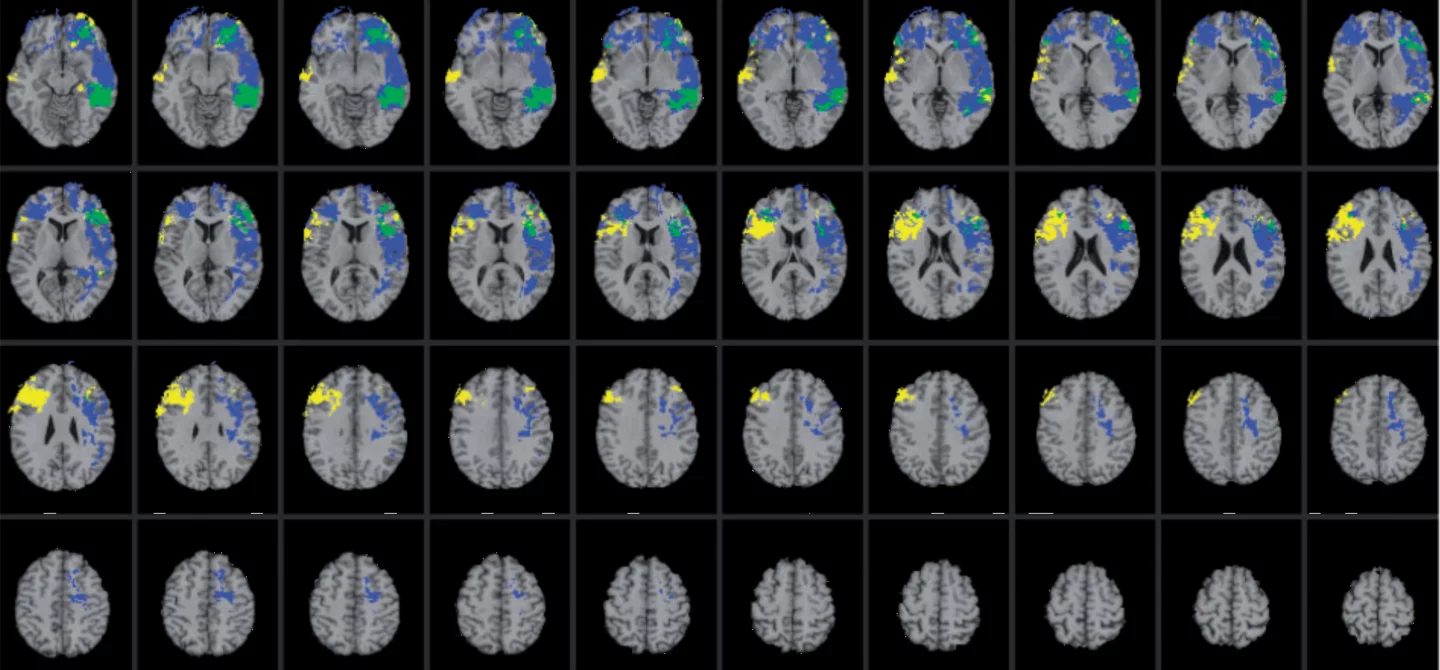 CT scan showing overlaps of different general and emotional intelligence functions