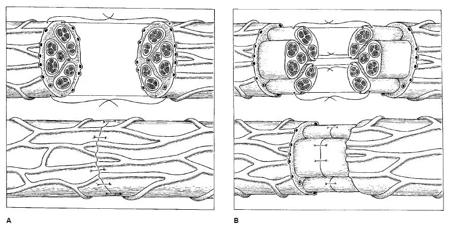 Conventional micro-surgical treatment of severed nerves (Image: Churchill Livingston Press)