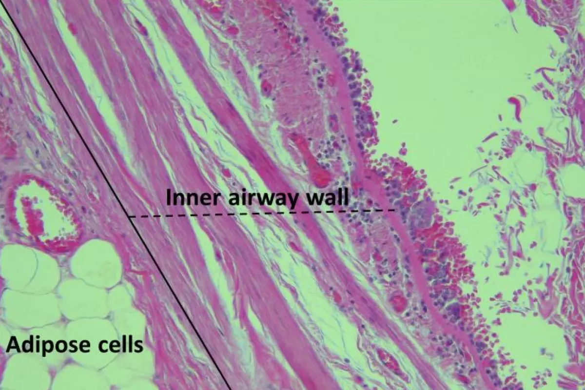 The research hypothesizes these fat accumulations to play a role in the onset of asthma and respiratory problems in obese individuals