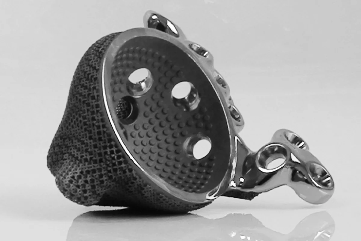 The 3D-printed implant that has given a once wheelchair-consigned teenager the ability to walk on her own