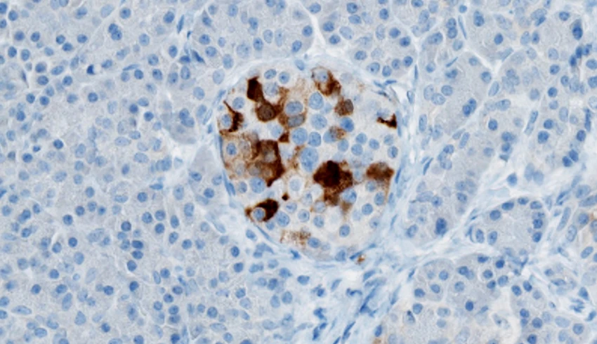 After identifying enteroviruses (shown here in pancreatic tissue in brown) as a possible trigger for the onset of type 1 diabetes, a team has developed a vaccine that could prevent the disease from developing in children
