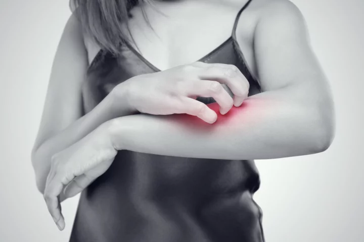 A common bacterium could be recruited to help sufferers of atopic dermatitis, otherwise known as atopic eczema