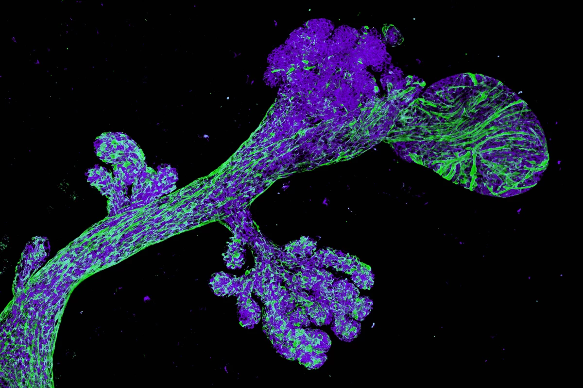 Researchers identified the cells that can lead to breast cancer in women with a mutated BRCA2 gene