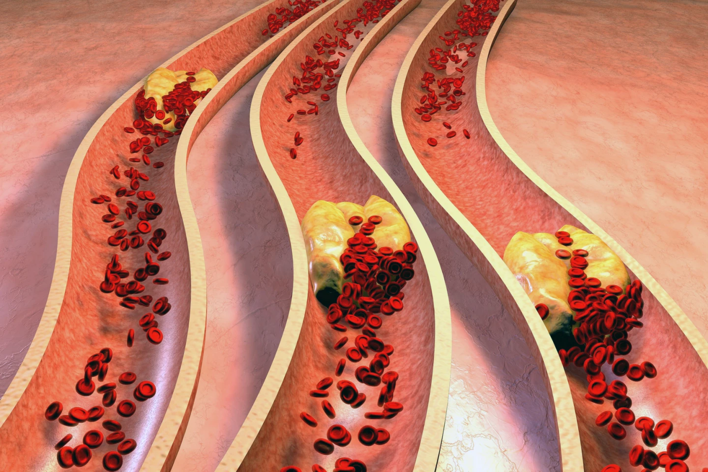 How atherosclerosis progresses so that arteries are completely blocked with plaque