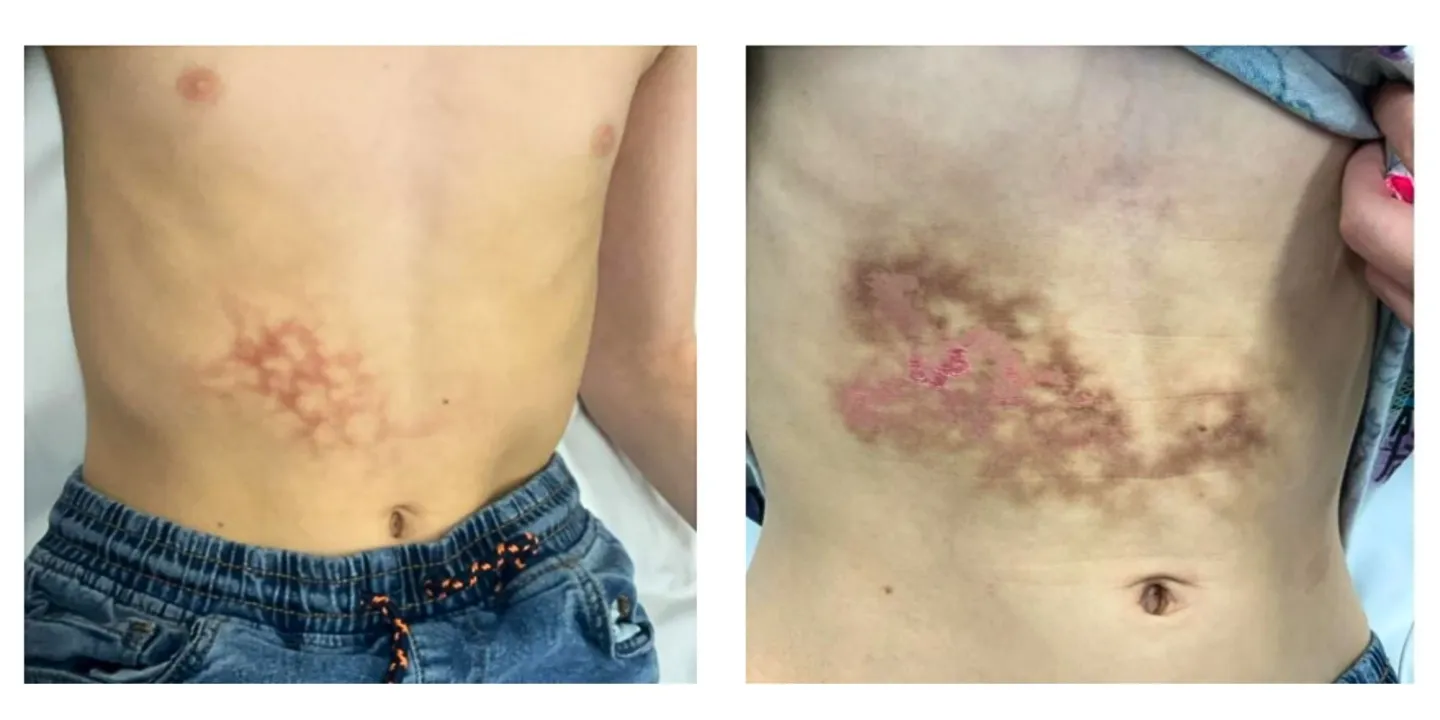 Case study pics of toasted skin