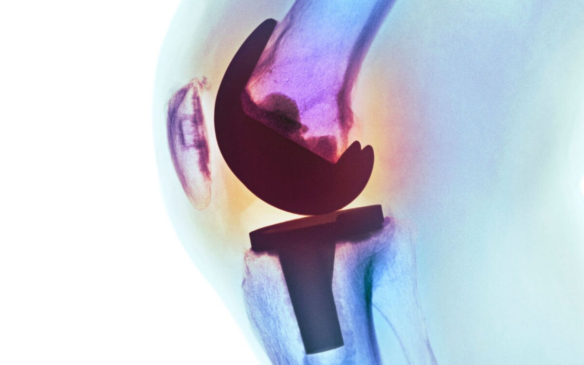 Particles from a joint replacement can enter your brain, study finds