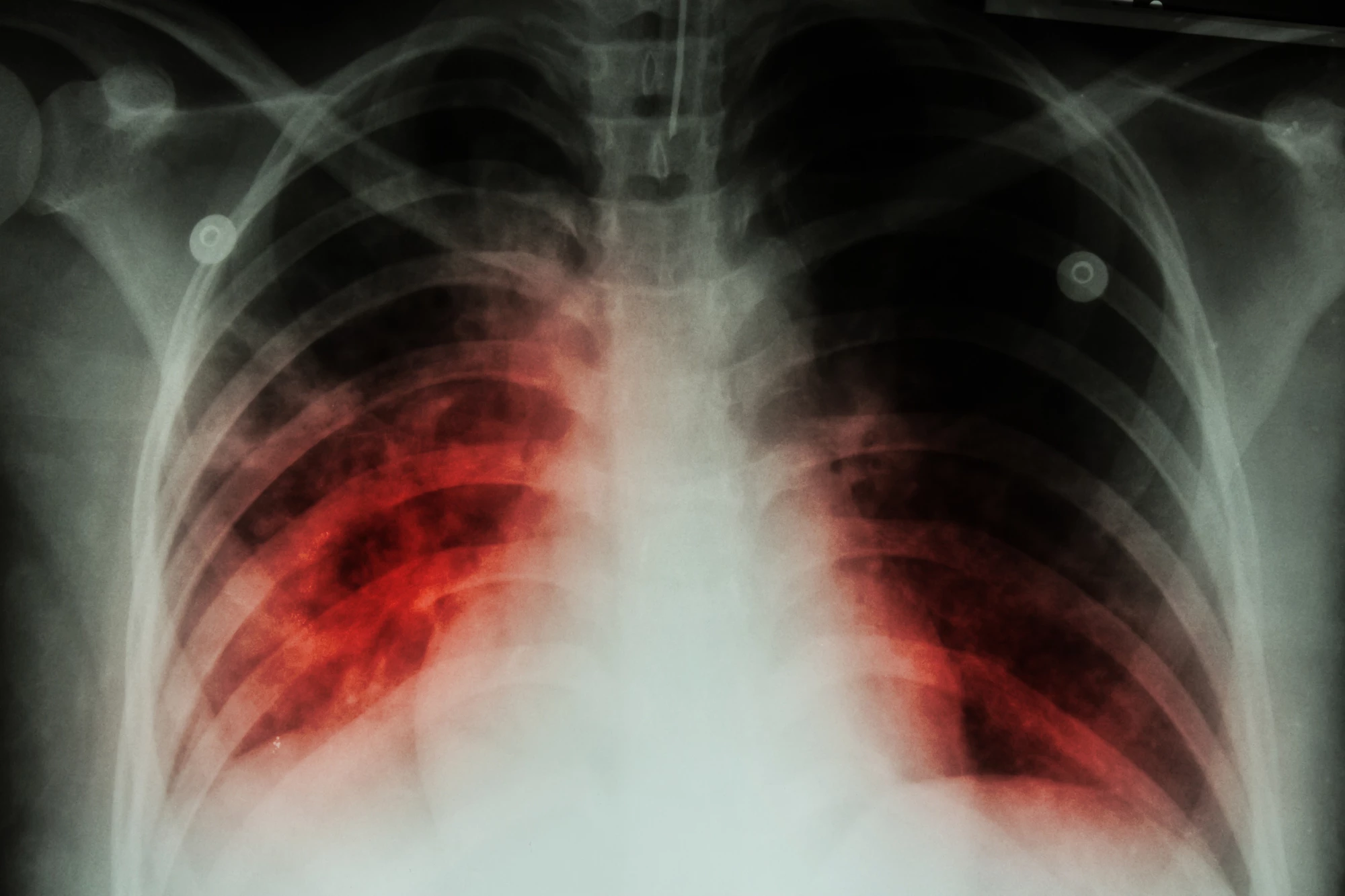 It's hoped a new vaccine will be the first new TB vaccine to be successfully developed in 100 years