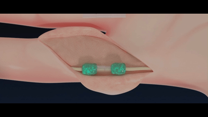 Tissium's nerve repair solution features a light-activated polymer (in green) that supports nerve healing and subsequently dissolves