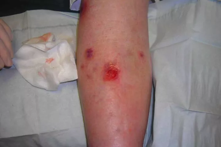 A solution containing skin cells and proteins has been shown to speed the healing of venous leg ulcers