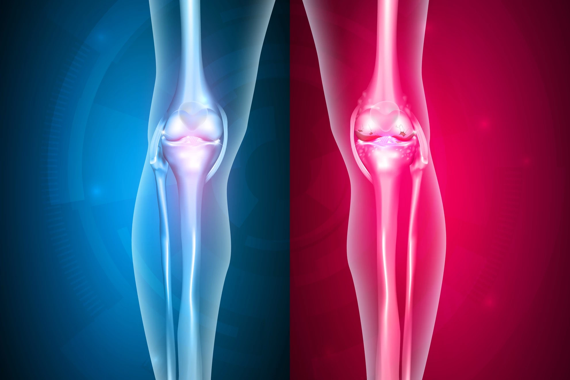 While it's rare, infections from joint replacements still affect hundreds of thousands of people a year