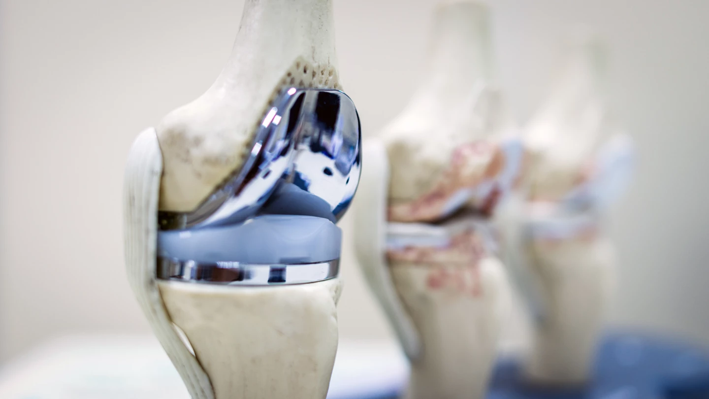 Mock-up of a total knee replacement showing the metal components and plastic spacer