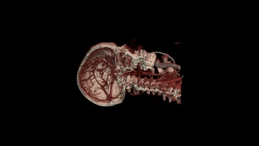 Computed tomography of brain vessels