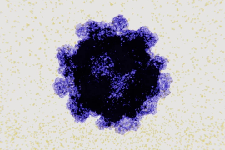 A study found norovirus, a common gastro infection, can trigger a process leading to Crohn's disease in people with certain genetic variants