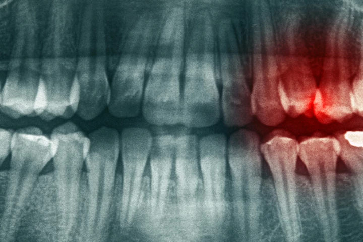 Combining exercise and omega-3 supplements reduced tooth infection severity