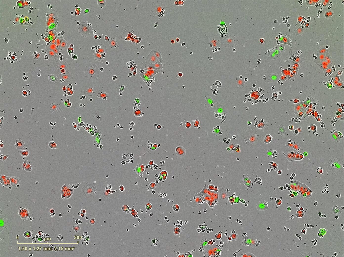 The study offers new insights into what triggers certain breast cancer cells to become dormant 'sleeper' cells (red) or remain active cancer cells (green).