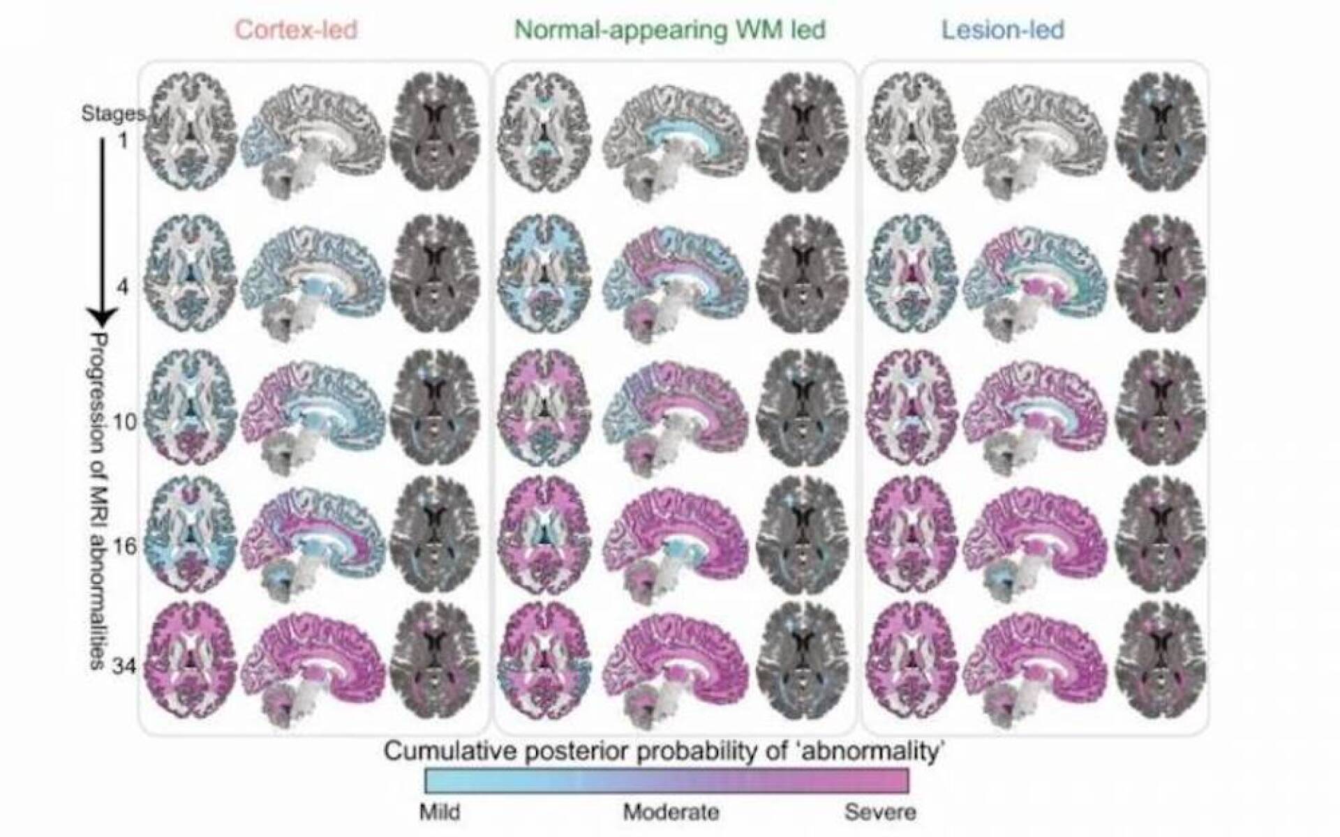 Ai Identifies Three Subtypes Of Multiple Sclerosis In Mri Brain Scans