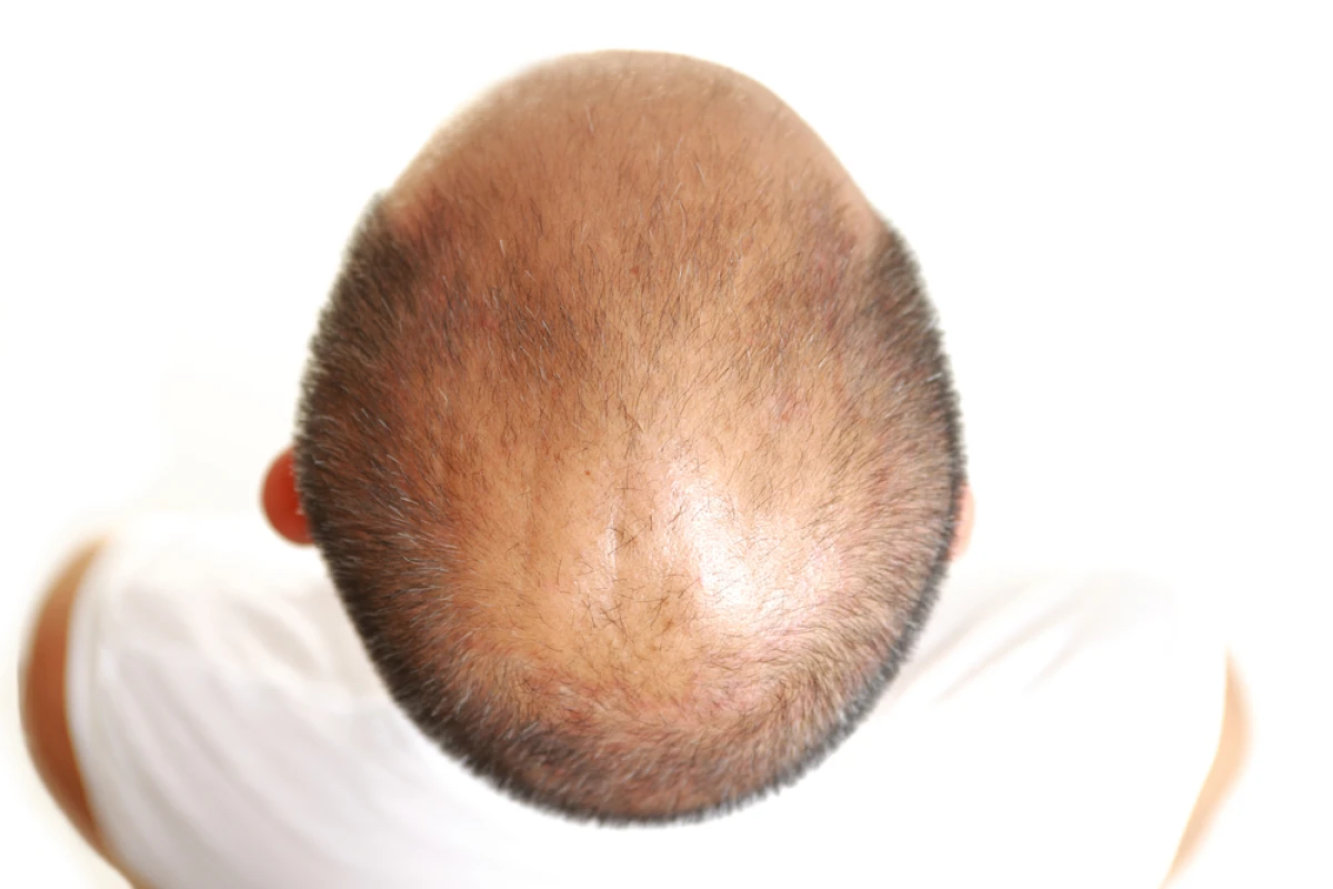 Scientists have found that by suppressing the activity of enzymes in hair follicles, they may be able to treat certain types of hair loss