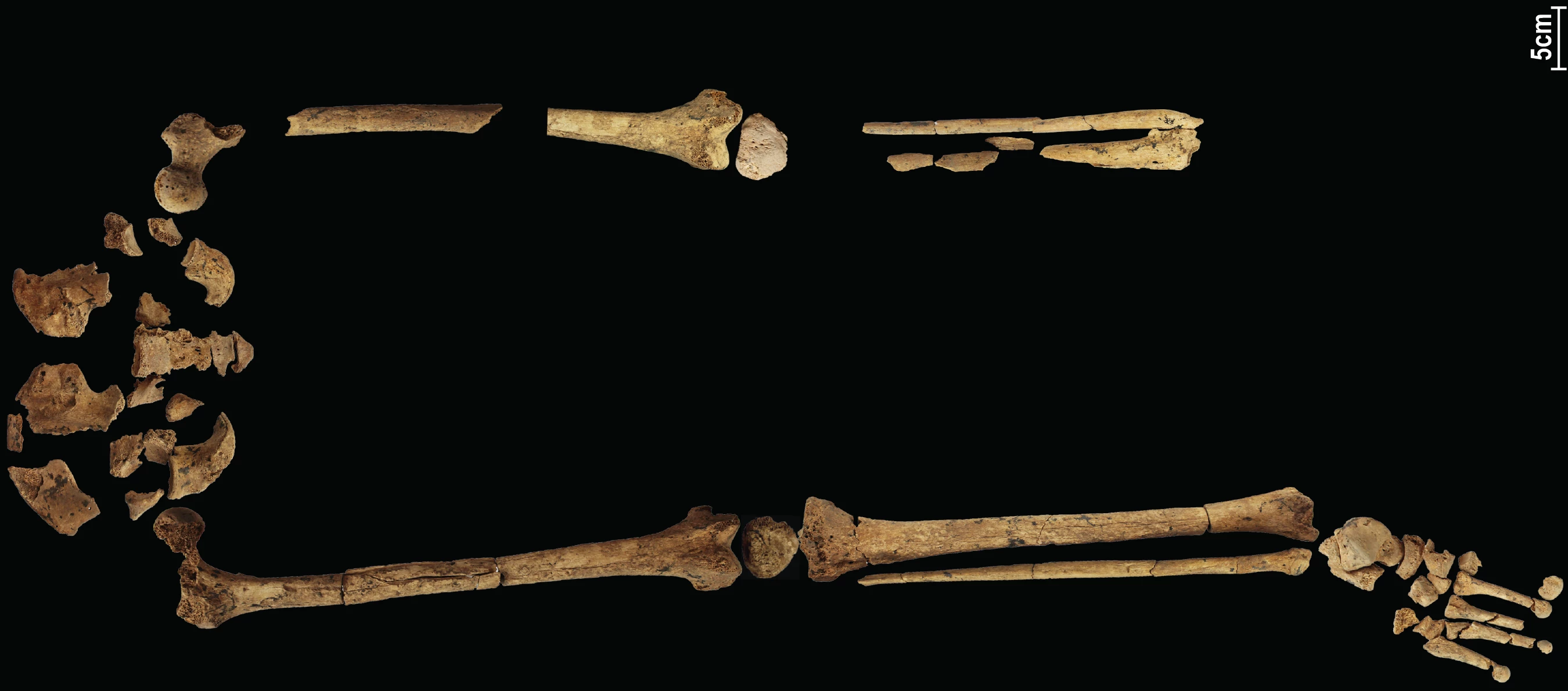 The 31,000-year-old remains are missing their lower left leg, with signs of healing around the wound that indicate it was a deliberate – and successful – amputation