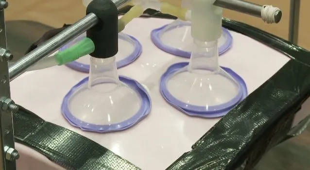 The R-Aide is designed to lift up obese patients' abdominal fat during surgery, allowing them to breathe more easily