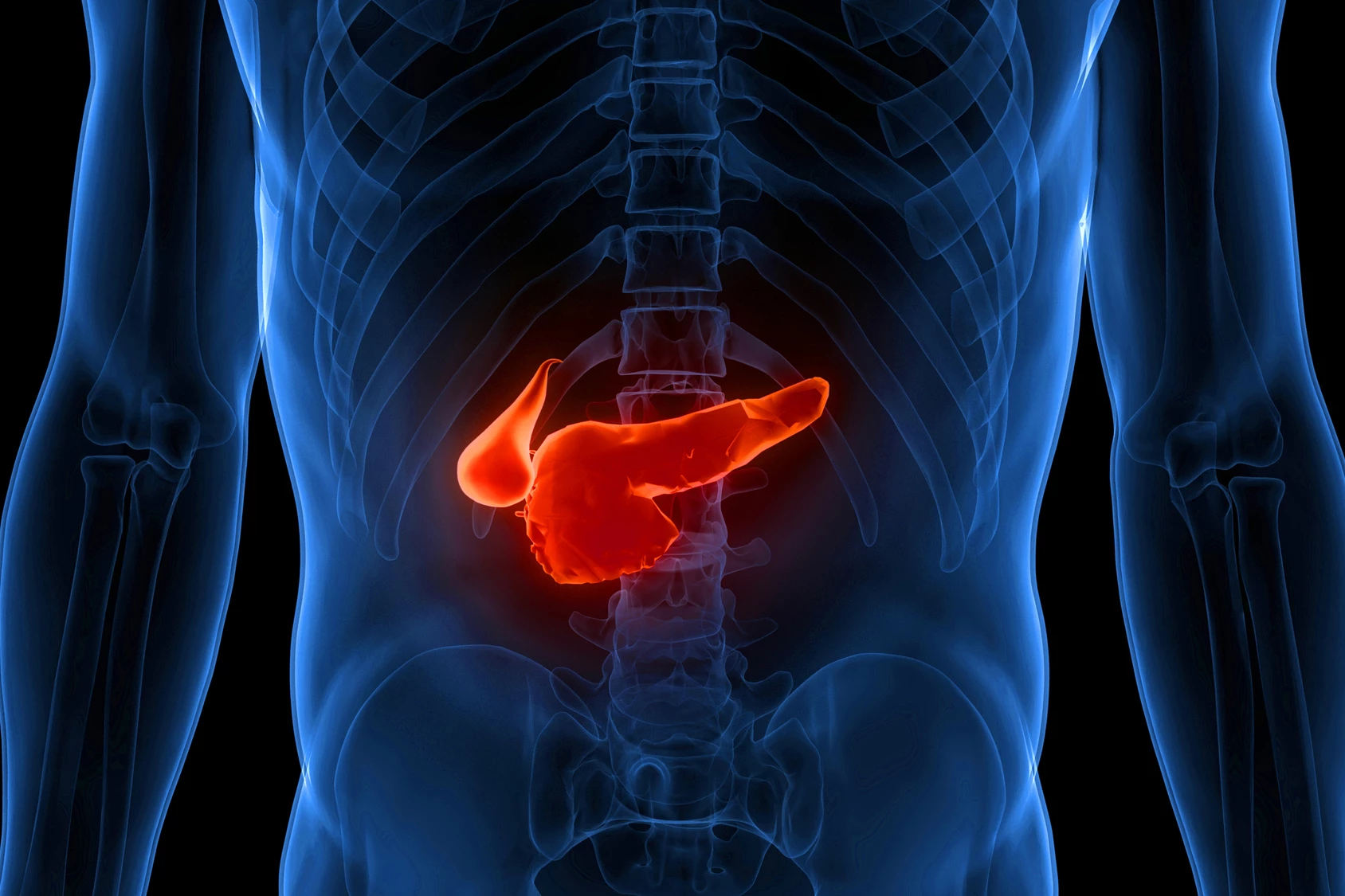 Researchers have used radioactive monoclonal antibodies to find and destroy pancreatic cancer cells