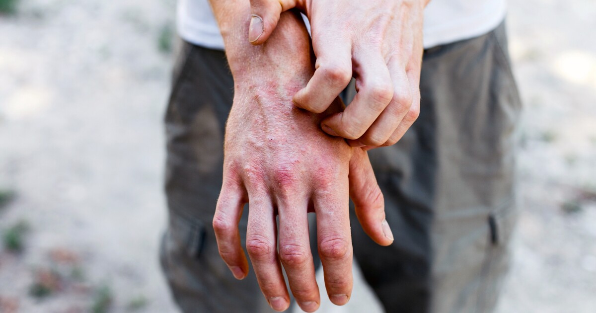 New treatment offers fast relief for severe eczema New treatment offers fast relief for severe eczema
