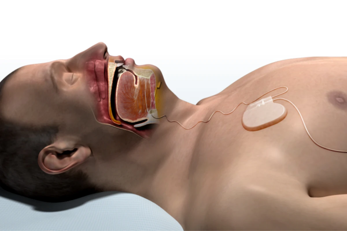 A rendering of a patient with the Inspire system installed