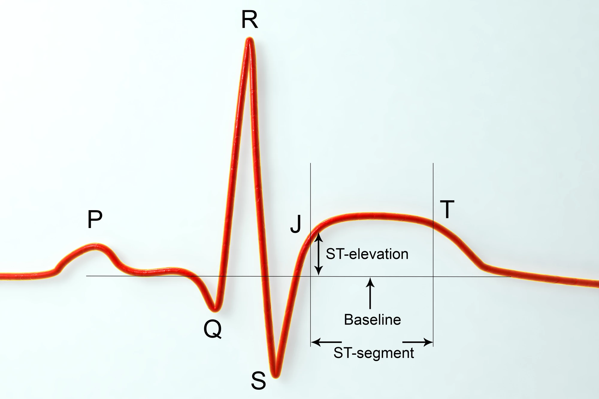 Illustration of an electrocardiogram (ECG) showing ST-segment elevation