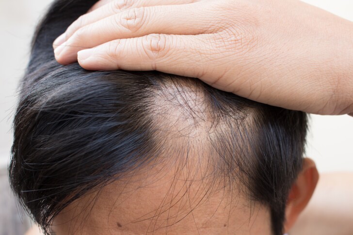 A common arthritis drug has shown promise in treating alopecia areata, which causes patchy hair loss